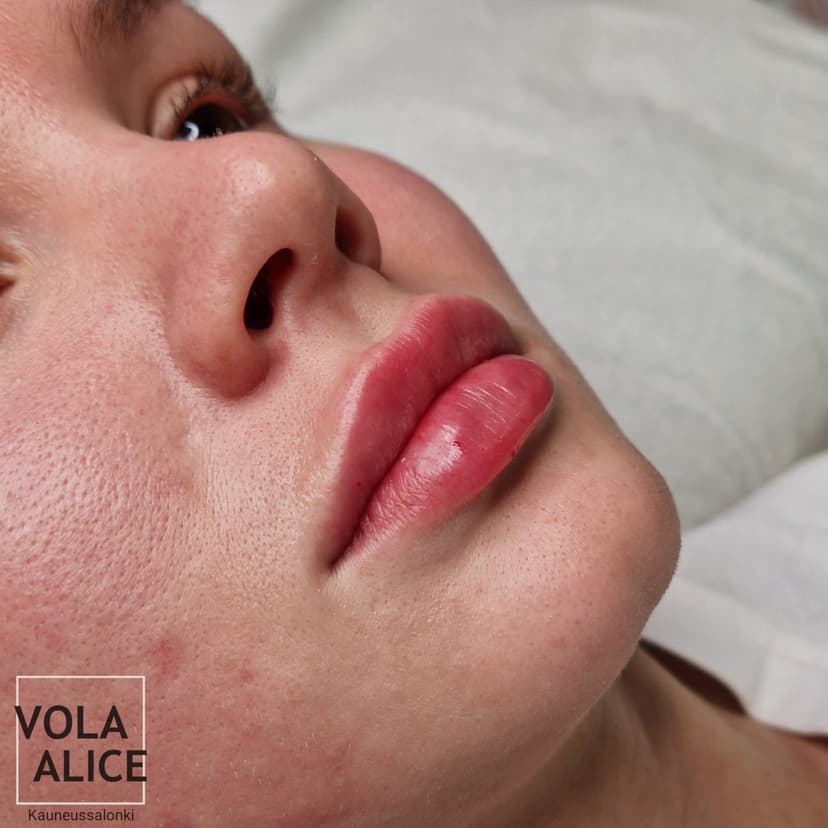 Täyteainehoito 1 ml | Lahti